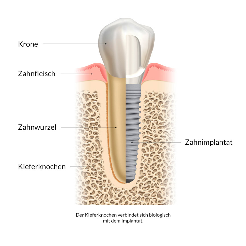 Schematischer Vergleich zwischen einem natürlichen Zahn und einem Implantat. Der Kieferknochen verbindet sich biologisch mit dem Implantat.